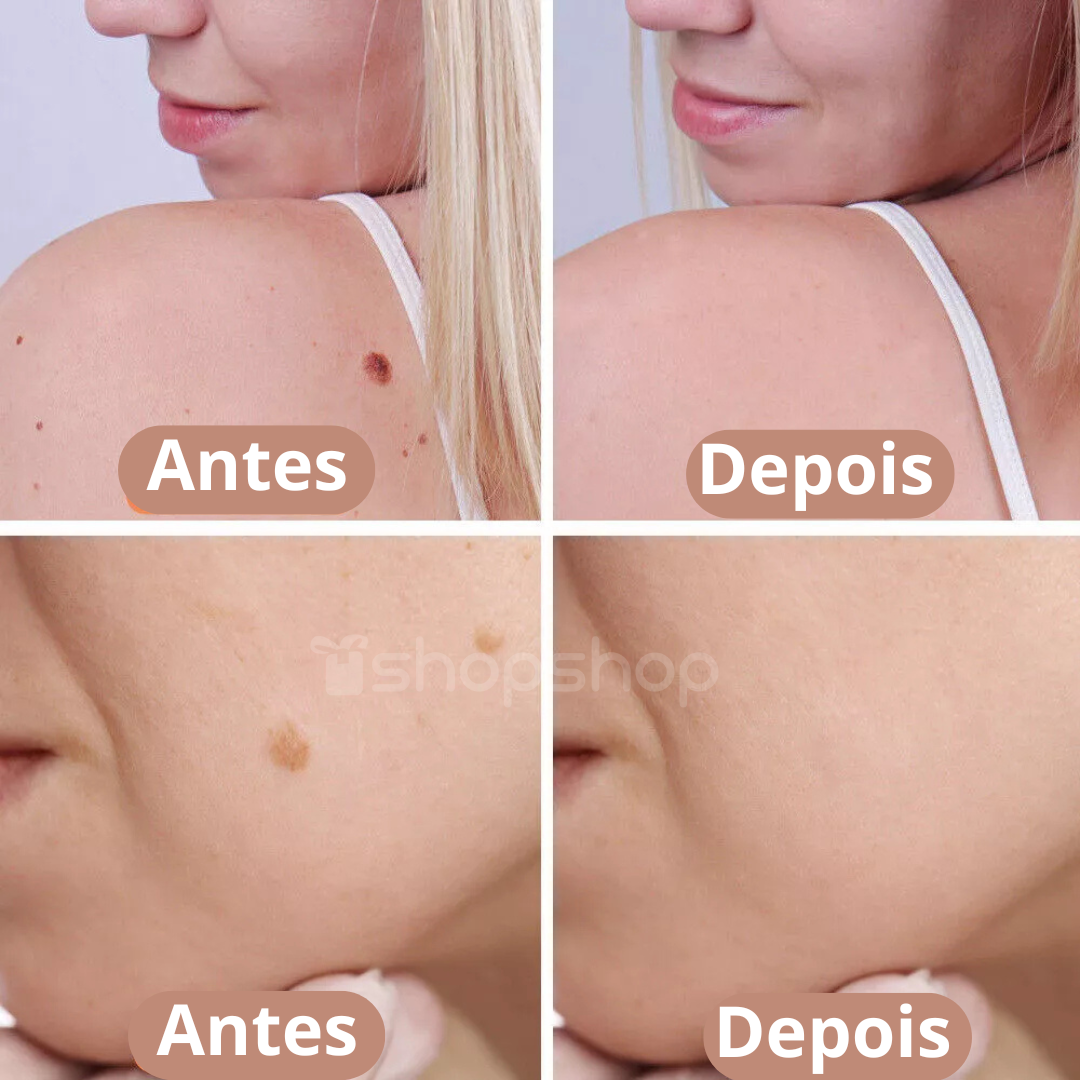 Caneta de Plasma para Remoção de Sinais, Verrugas e Rugas