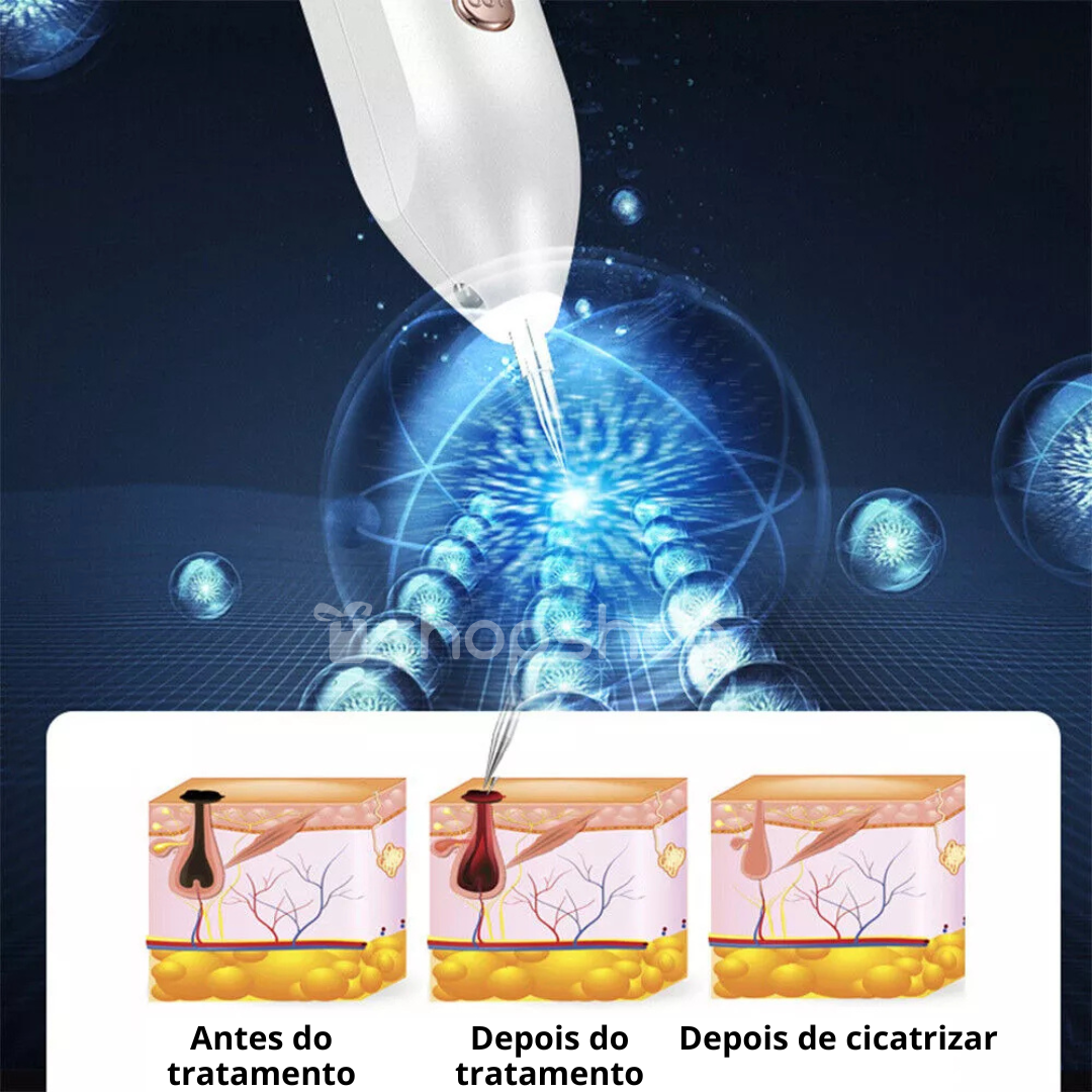 Caneta de Plasma para Remoção de Sinais, Verrugas e Rugas