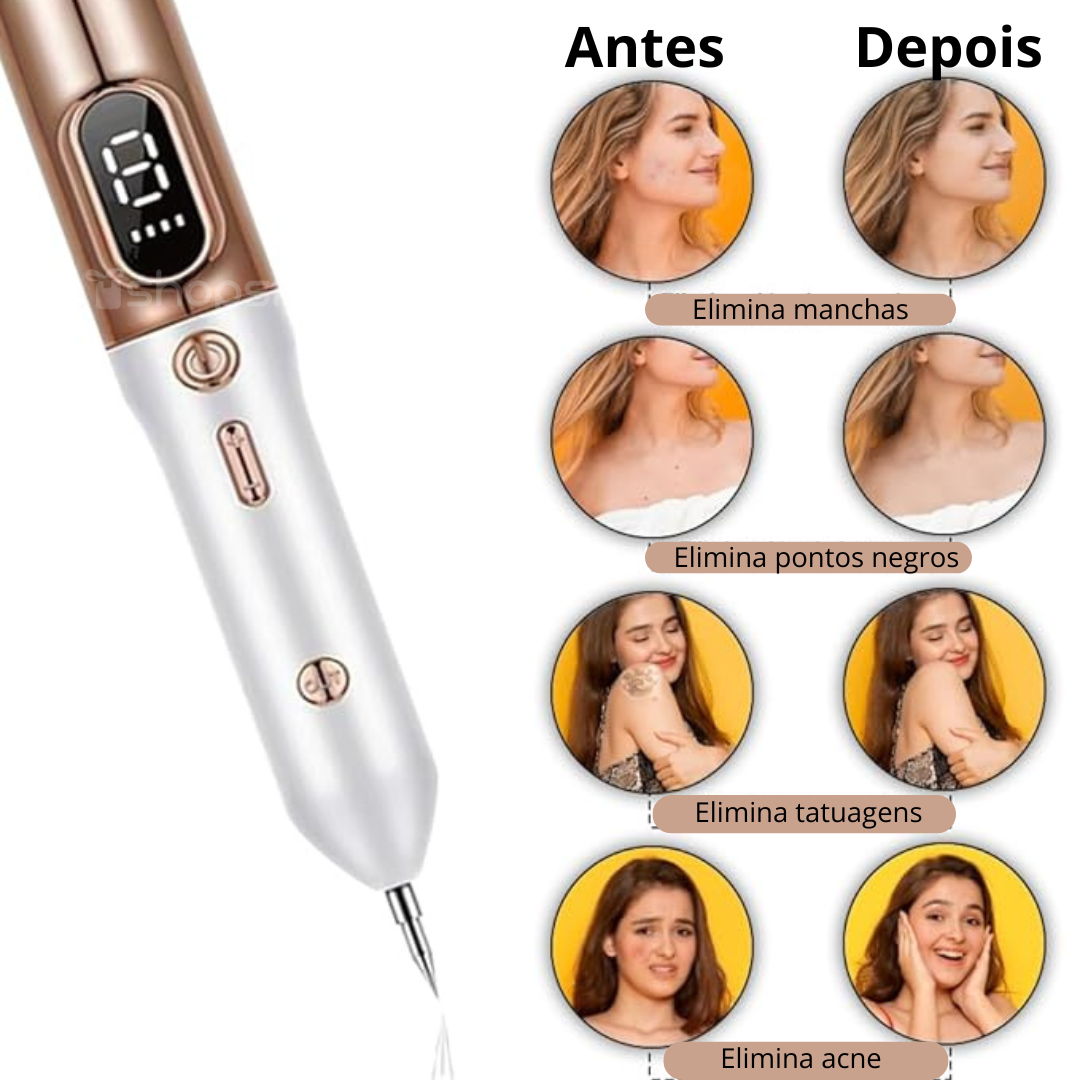 Caneta de Plasma para Remoção de Sinais, Verrugas e Rugas